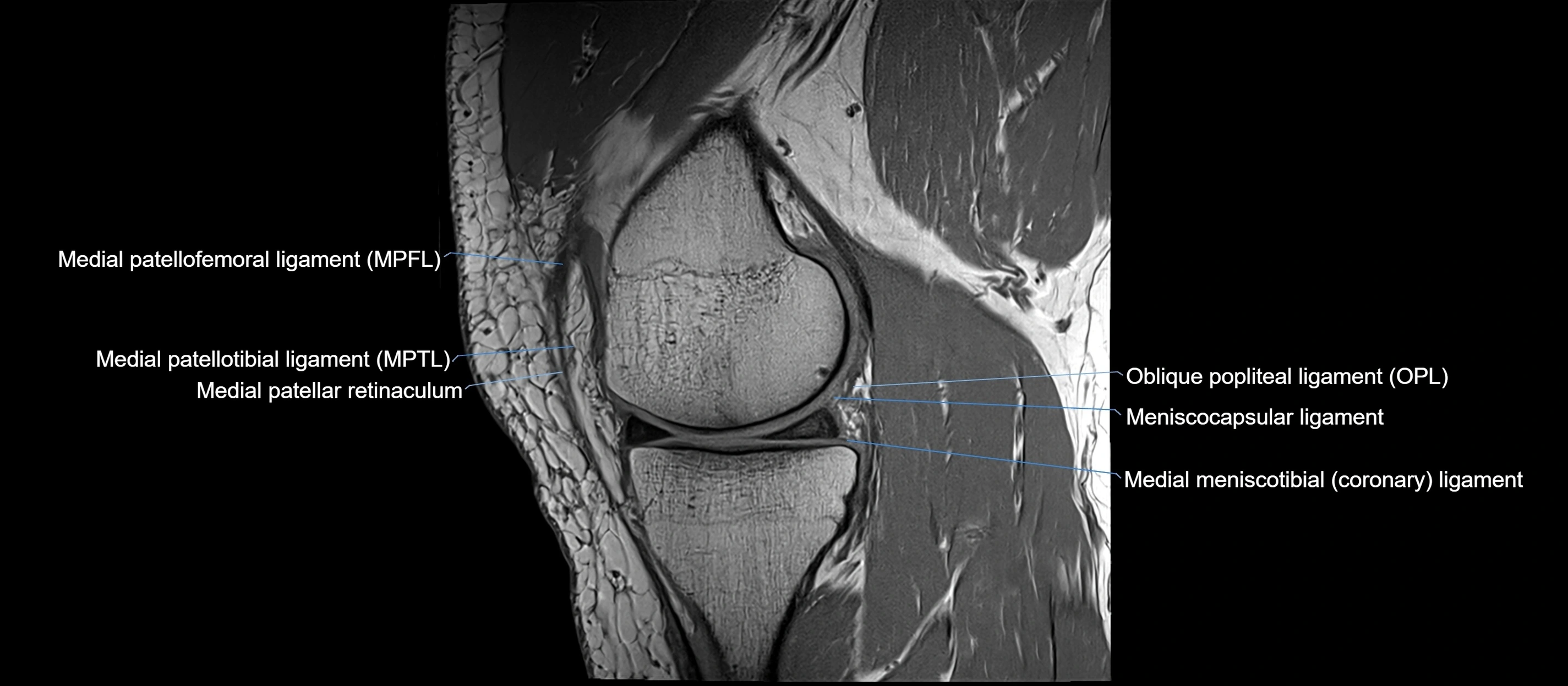 MRI sagittal  ligaments cross sectional anatomy 3T  radiology  image-img-00001-00017.webp